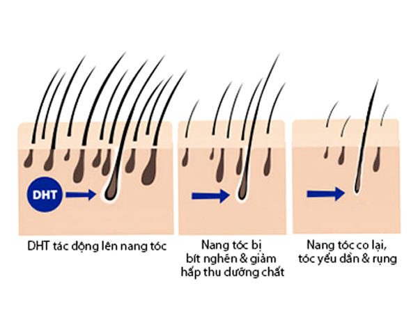 Quá trình rụng tóc thường gặp do bị ảnh hưởng bới các loại bệnh về da đầu